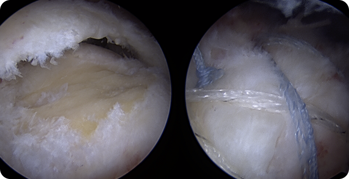 최소절개 관절내시경