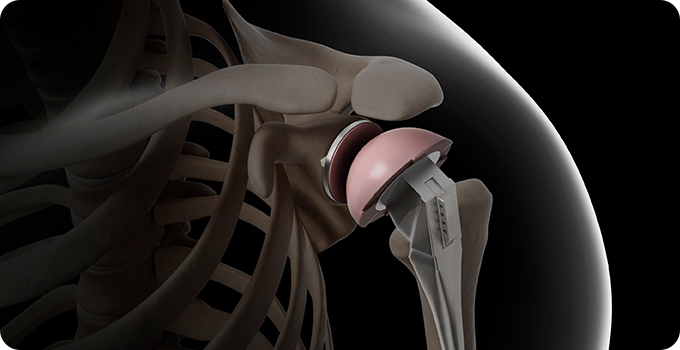 인공관절 수술 치료 사진