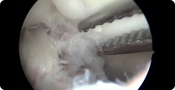 최소절대 관절내시경 치료 사진