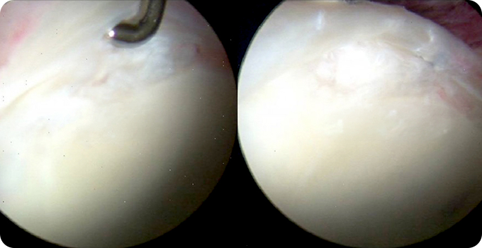 최소절개 관절내시경 치료 사진