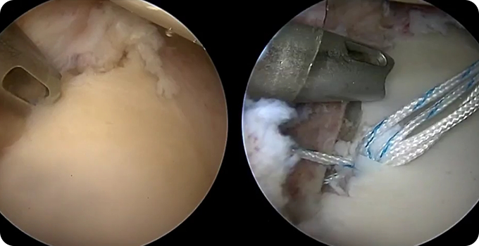 최소절개 관절내시경 치료 사진