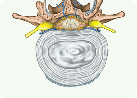 목 디스크 초기 사진
