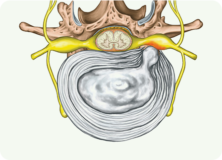 목 디스크 탈출 사진