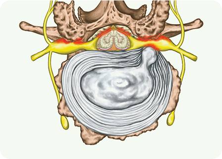 목 디스크 파열 사진