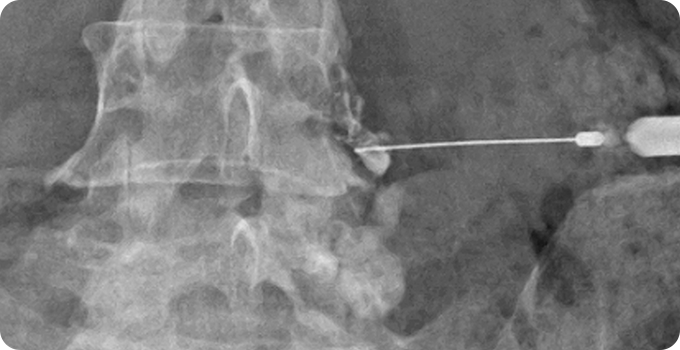 신경차단술 사진