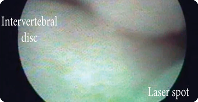 신경성형술 사진