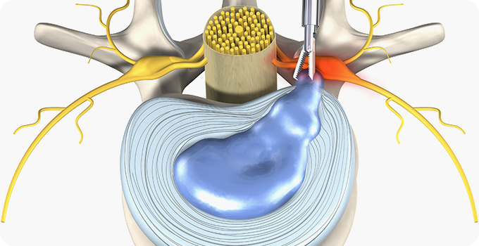 최소절개 척추내시경 사진