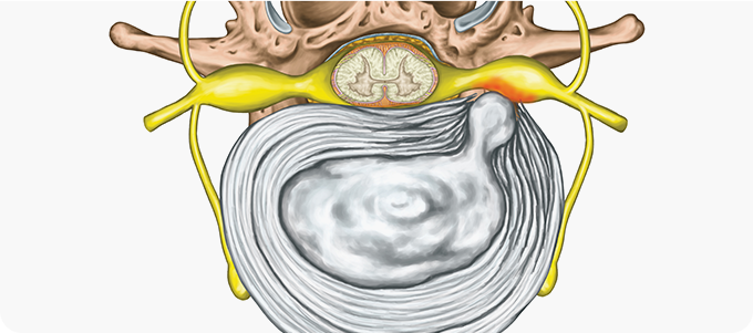 허리디스크 관련 이미지