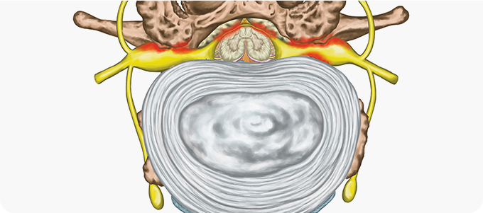척추관 협착증 관련 이미지