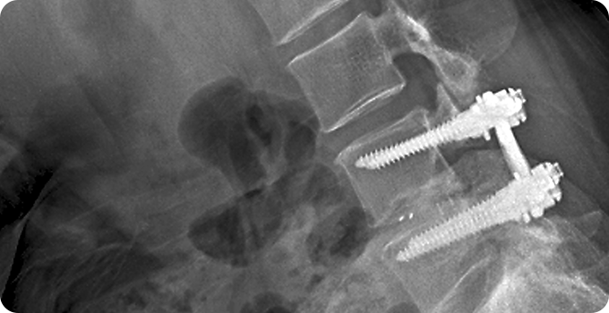 척추 고정술 사진