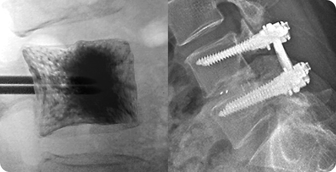 척추 성형술&고정술 사진