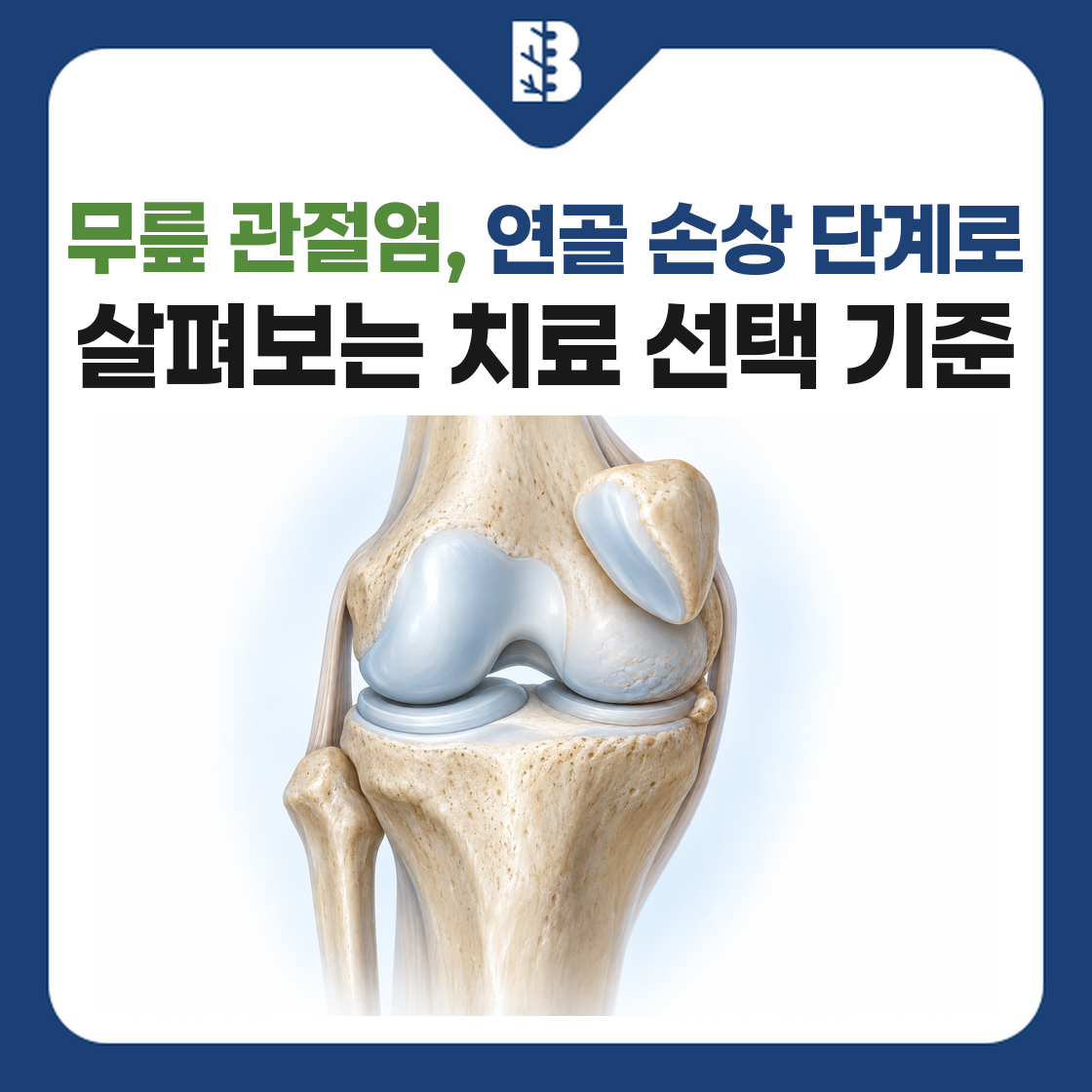 무릎 관절염의 연골 손상과 치료 선택 기준을 안내하는 썸네일