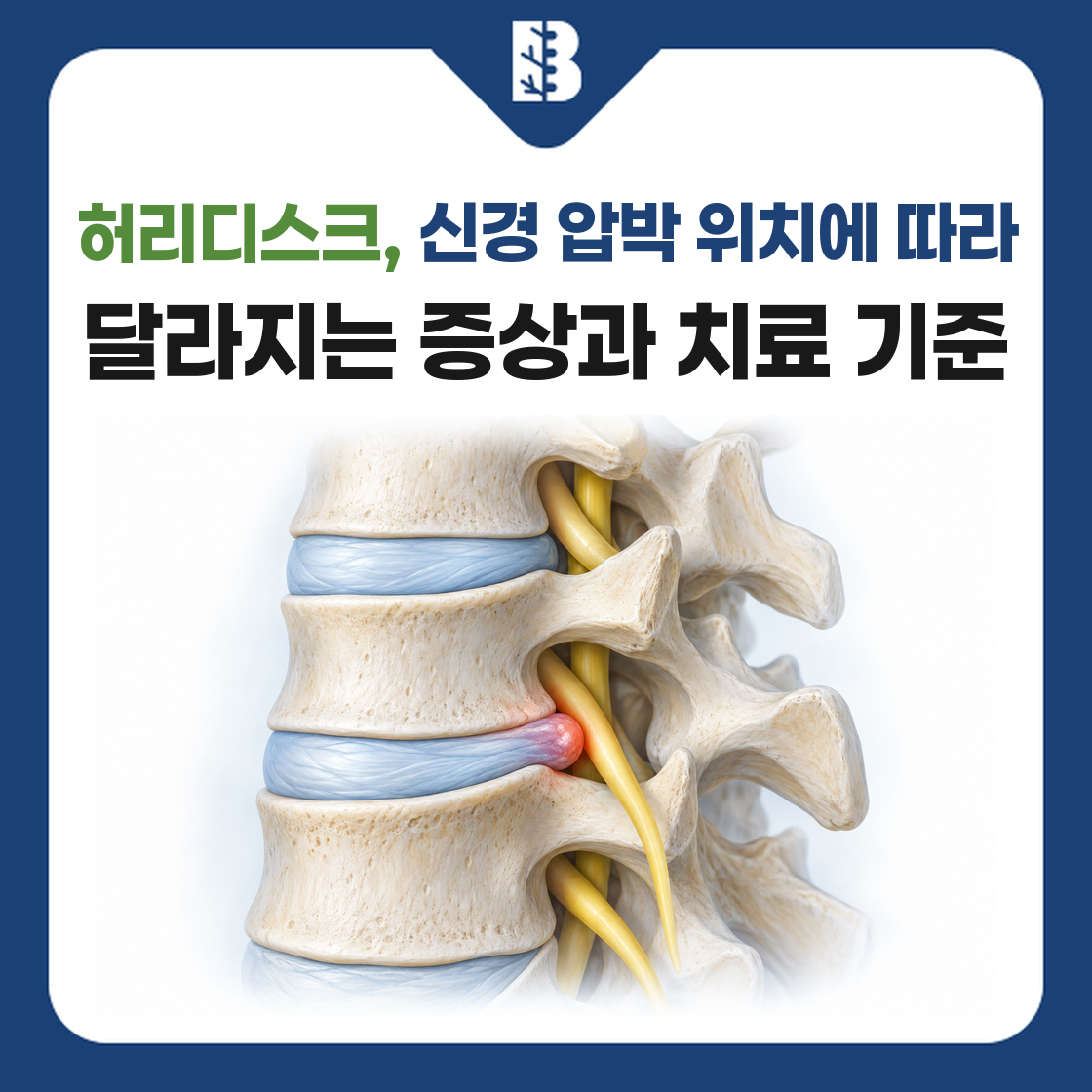 허리디스크의 신경 압박 위치와 증상·치료 기준을 안내하는 본바움병원 썸네일