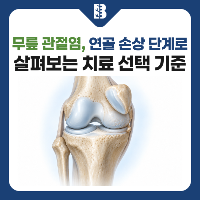 무릎 관절염의 연골 손상과 치료 선택 기준을 안내하는 썸네일