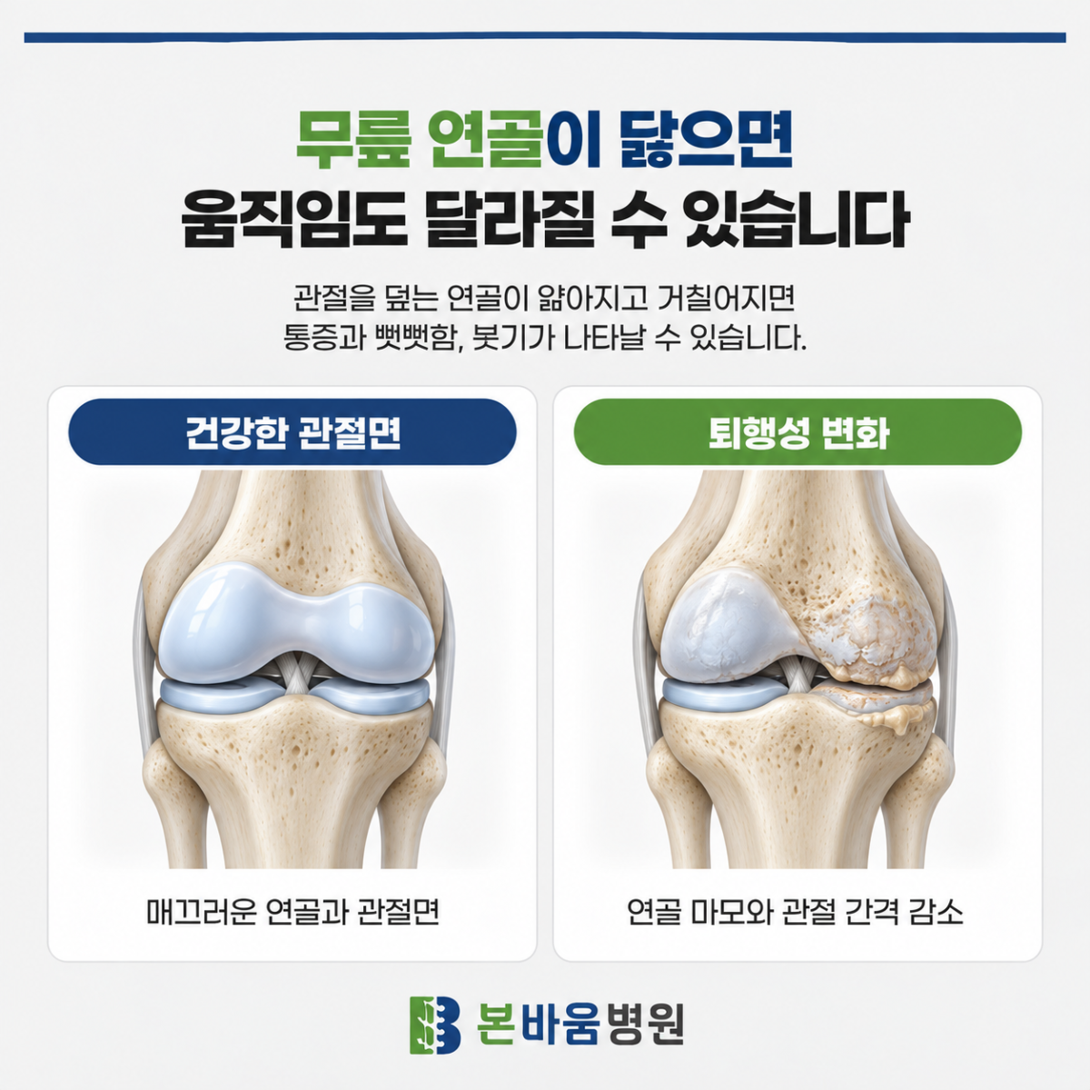 건강한 무릎 관절면과 연골 마모·관절 간격 감소 비교