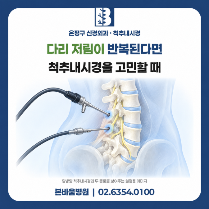 양방향 척추내시경의 카메라와 수술 기구 접근을 설명하는 일러스트
