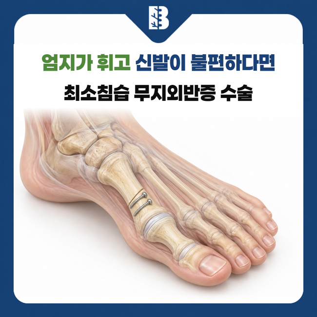 연신내정형외과 첫째 발허리뼈의 정렬 교정과 내부 고정 나사를 보여주는 발 구조