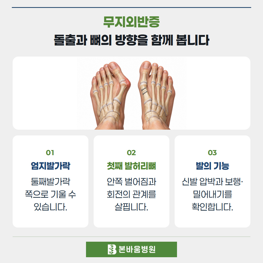 연신내정형외과 무지외반 변형과 발 정렬 모델 — 무지외반증 · 돌출과 뼈의 방향을 함께 봅니다