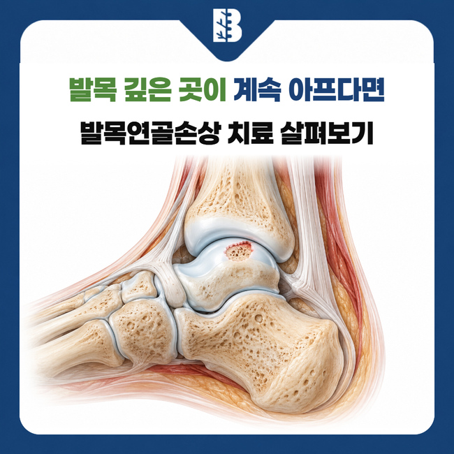 녹번역정형외과 거골 관절면의 연골과 아래 뼈에 생긴 골연골 병변 그림