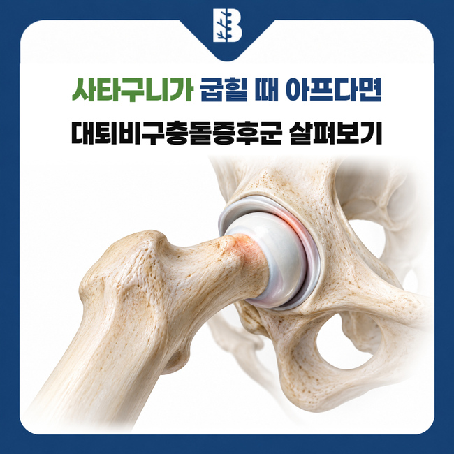 은평구정형외과 고관절을 굽힐 때 넙다리뼈 목과 비구 가장자리가 맞닿는 구조 그림
