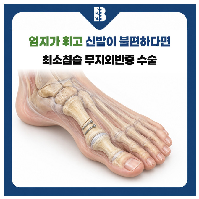 연신내정형외과 첫째 발허리뼈의 정렬 교정과 내부 고정 나사를 보여주는 발 구조