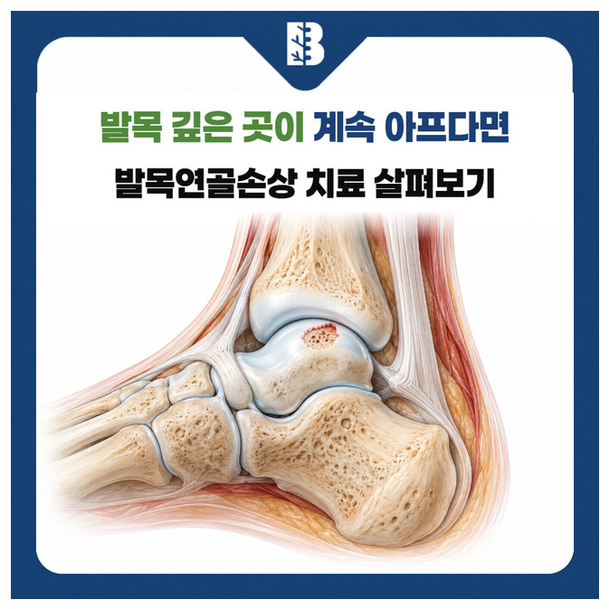 녹번역정형외과 거골 관절면의 연골과 아래 뼈에 생긴 골연골 병변 그림