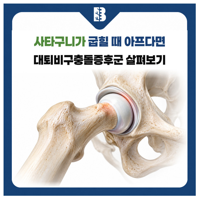 은평구정형외과 고관절을 굽힐 때 넙다리뼈 목과 비구 가장자리가 맞닿는 구조 그림